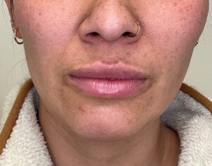 After Image: Lip Filler