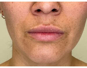 Before Image: Lip Filler