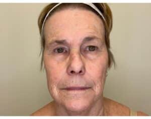 Before Image: Facial Fillers