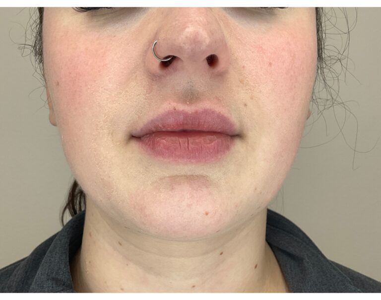 Before Image: Lip Filler - front