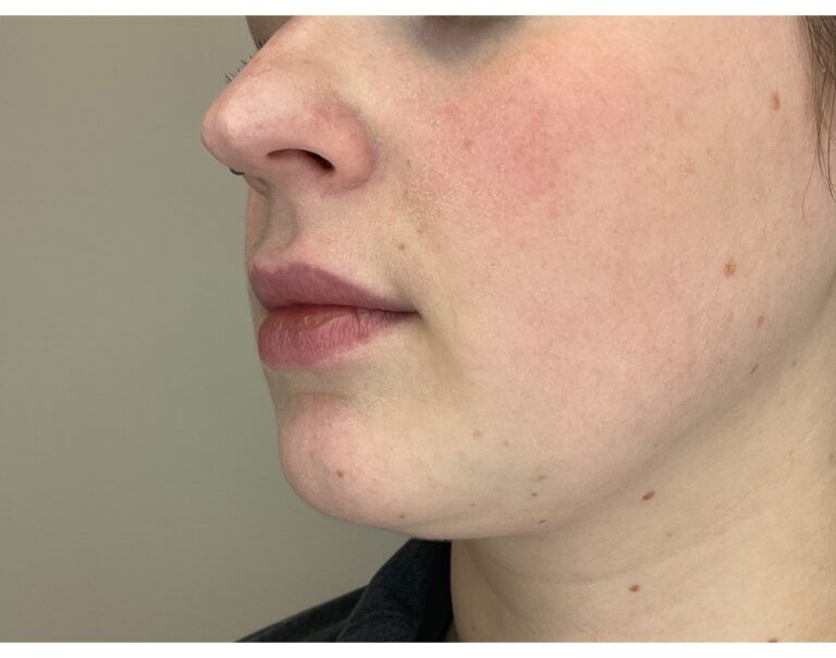 Before Image: Lip Filler - left-front-oblique