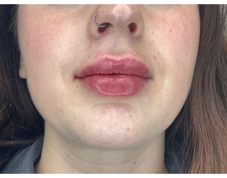 After Image: Lip Filler - front