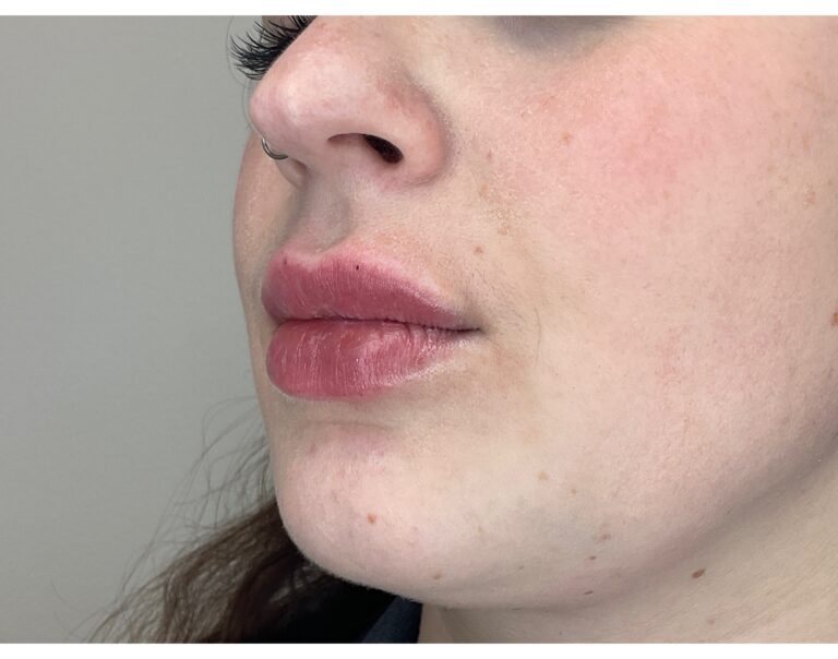 After Image: Lip Filler - left-front-oblique