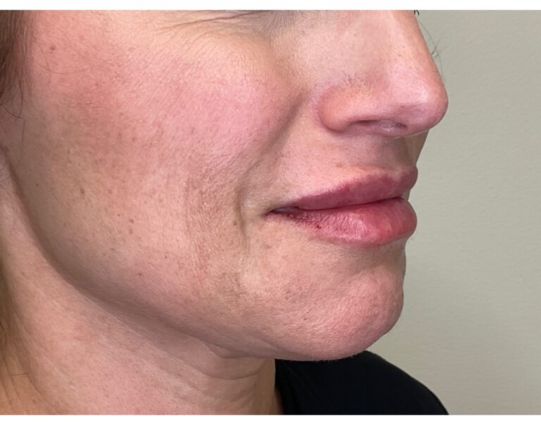 After Image: Lip Filler - right-front-oblique