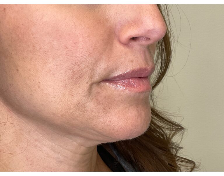 Before Image: Lip Filler - right-front-oblique