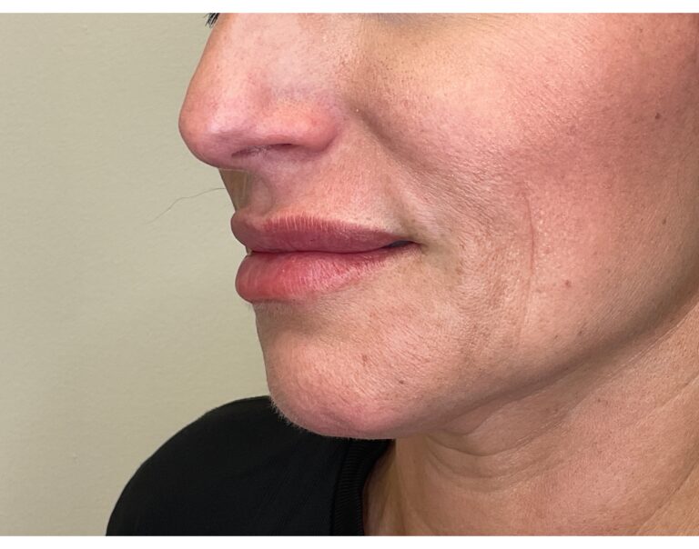 After Image: Lip Filler - left-front-oblique