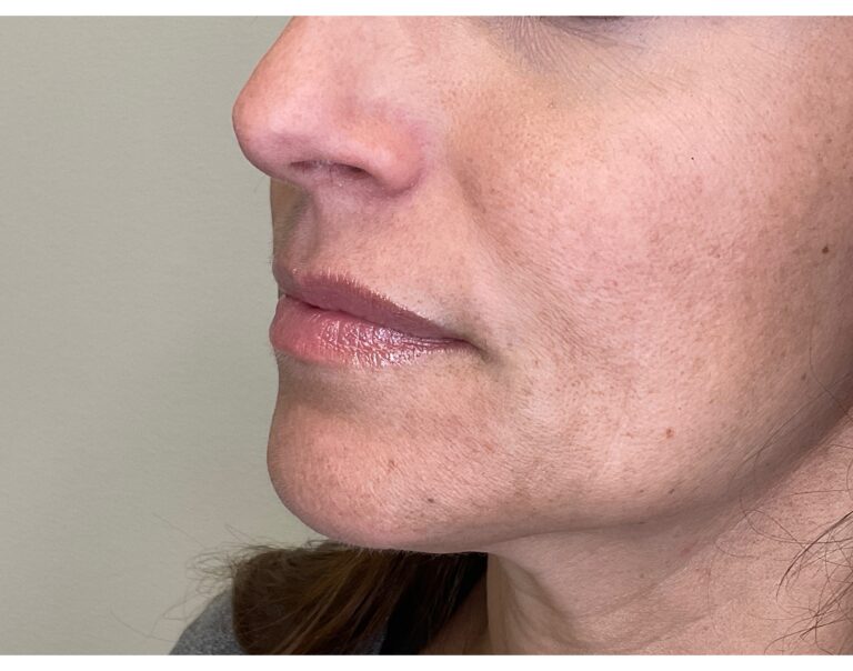 Before Image: Lip Filler - left-front-oblique