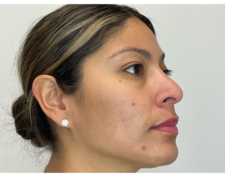 After Image: PicoSure, Diamond Glow & SkinMedica - right-front-oblique