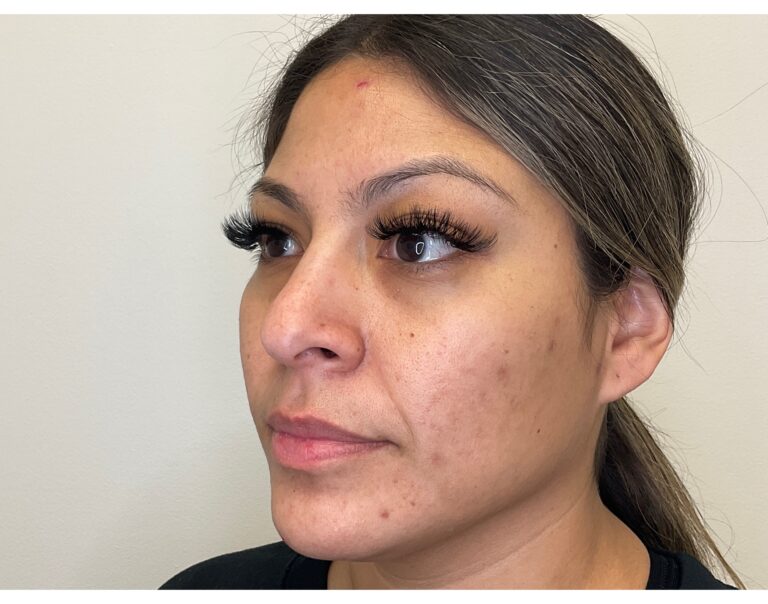 Before Image: PicoSure, Diamond Glow & SkinMedica - left-front-oblique