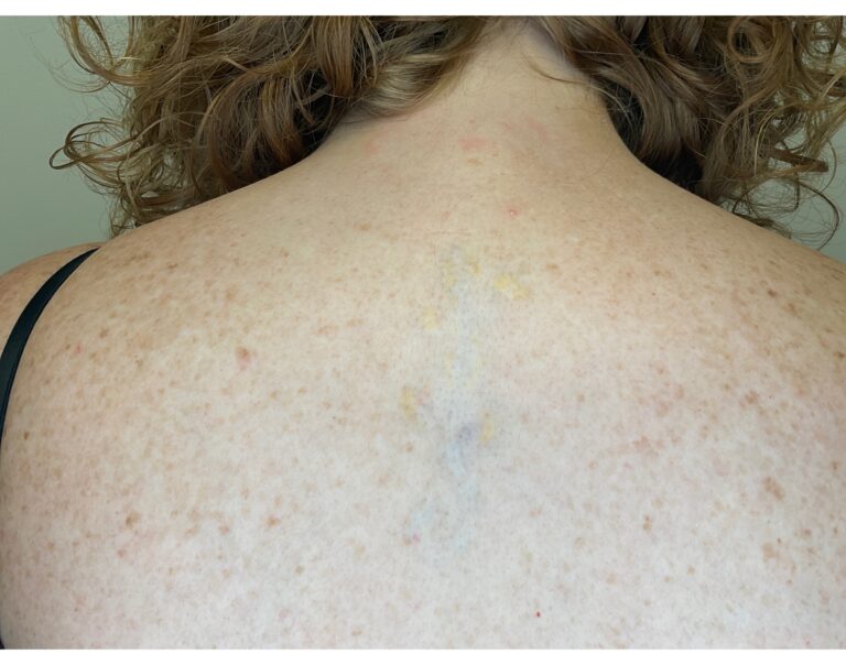 After Image: Tattoo Removal - front