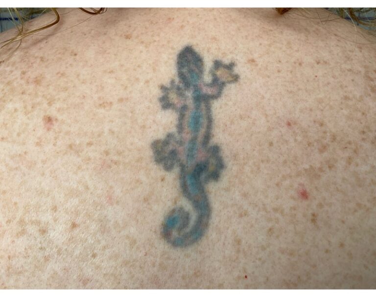 Before Image: Tattoo Removal - front