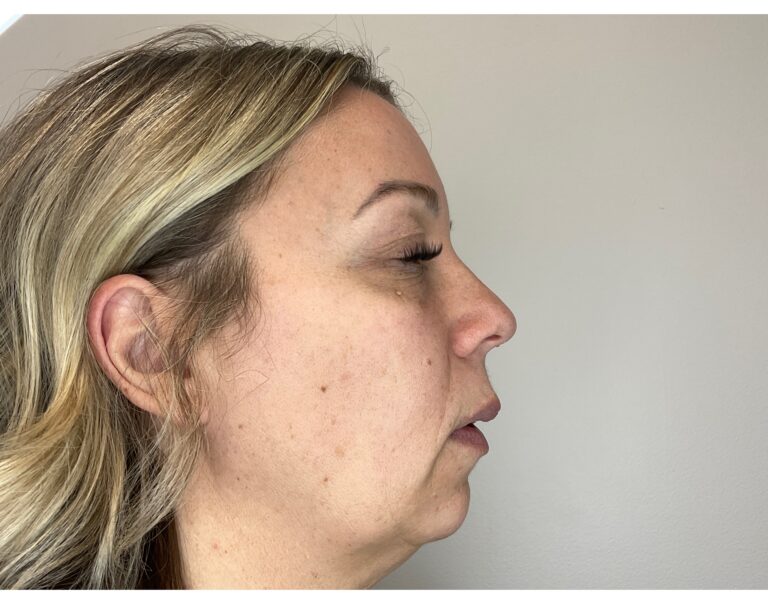 Before Image: Facial Fillers - right-side