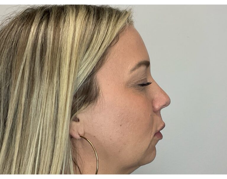 After Image: Facial Fillers - right-side