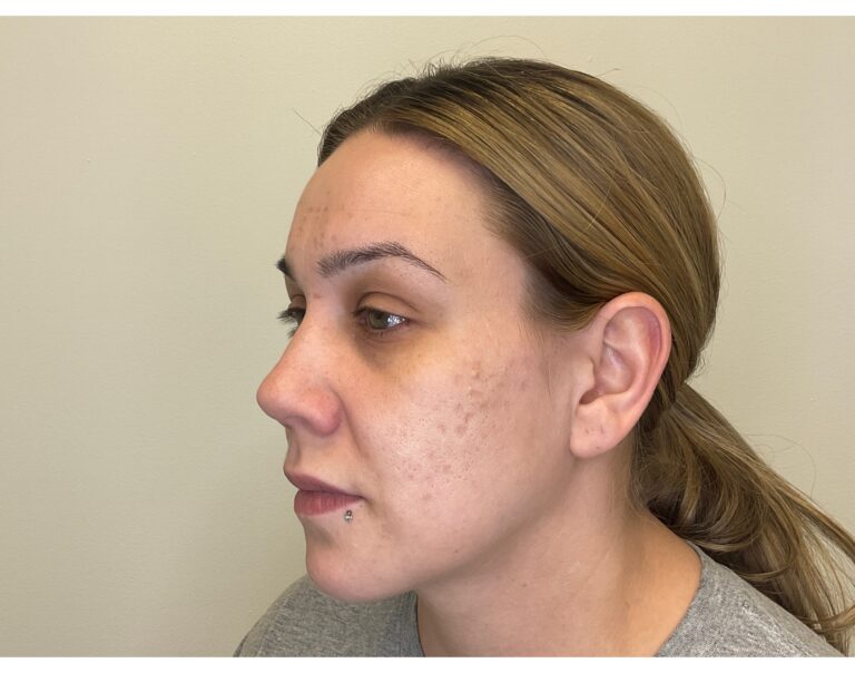 Before Image: Potenza RF Microneedling for Acne Scars - left-side