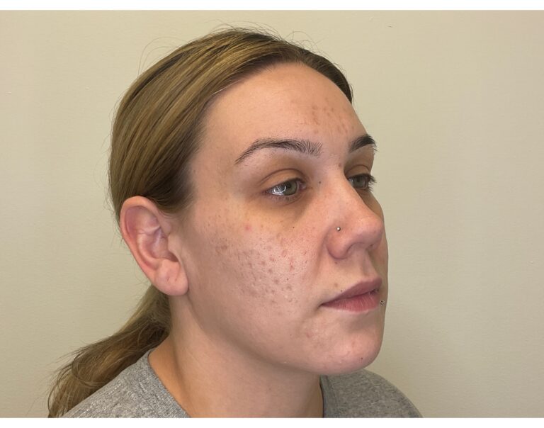 Before Image: Potenza RF Microneedling for Acne Scars - right-front-oblique