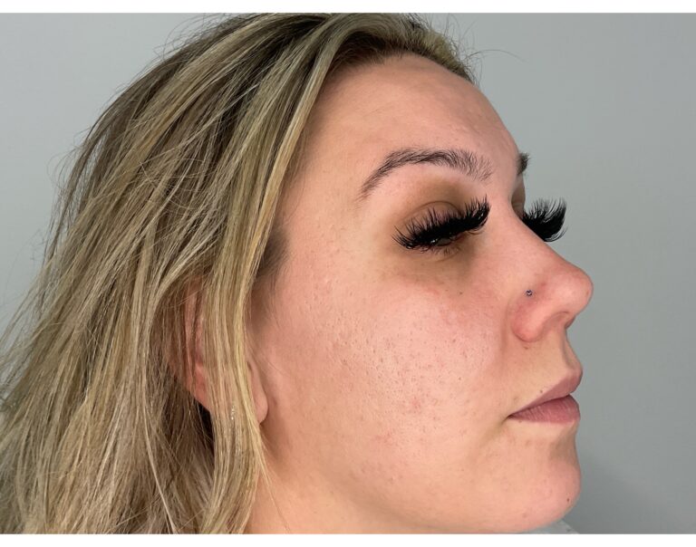 After Image: Potenza RF Microneedling for Acne Scars - right-front-oblique