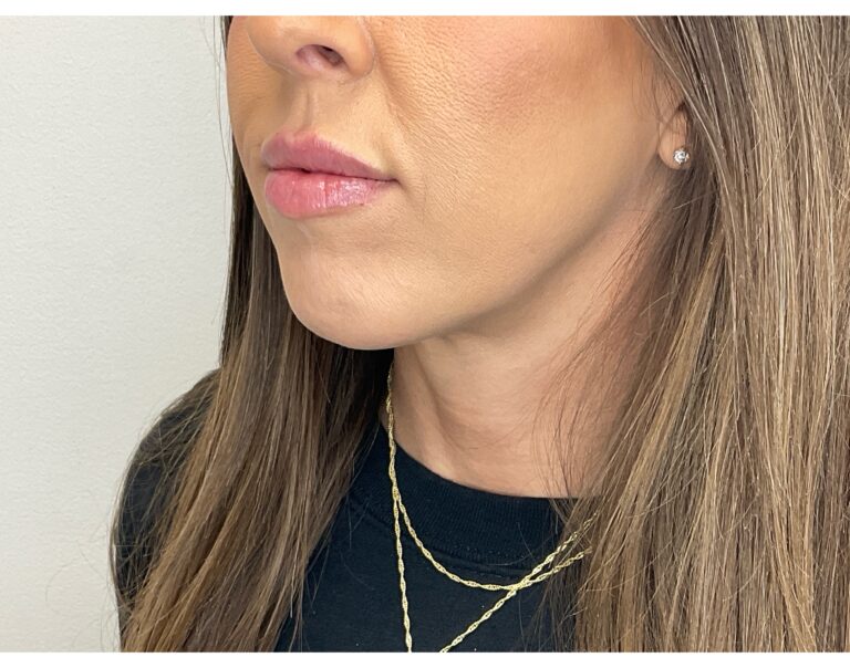 After Image: Lip Filler - left-front-oblique