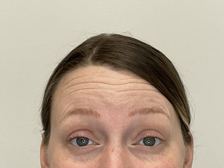 Before Image: Botox - front