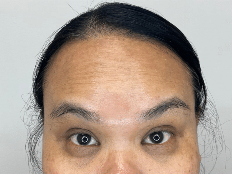 After Image: Botox - front