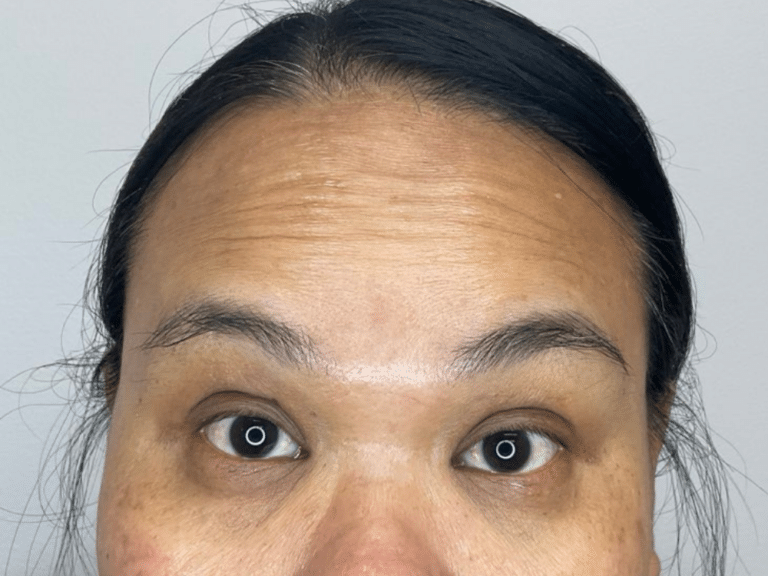 Before Image: Botox - front